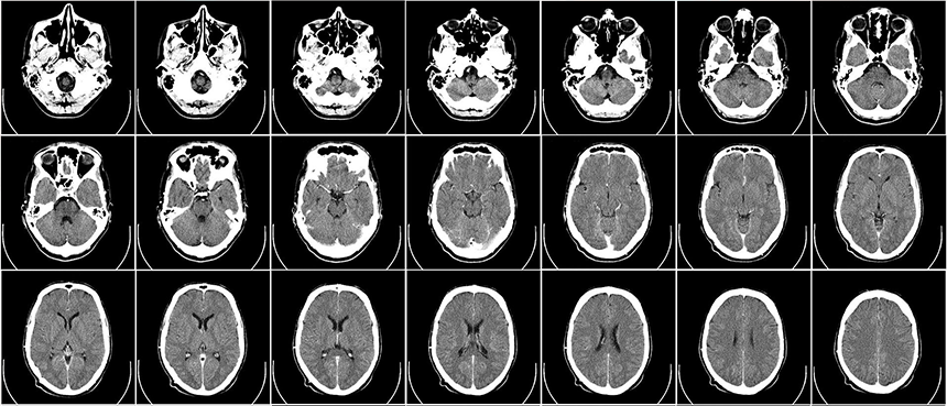 There are so many different types of brain tumors in adults that it's hard to talk about them all at once. However, it is said that malignant glioma is difficult to cure until now, but the survival rate continues to increase thanks to the development of surgery, radiation therapy, and chemotherapy.
